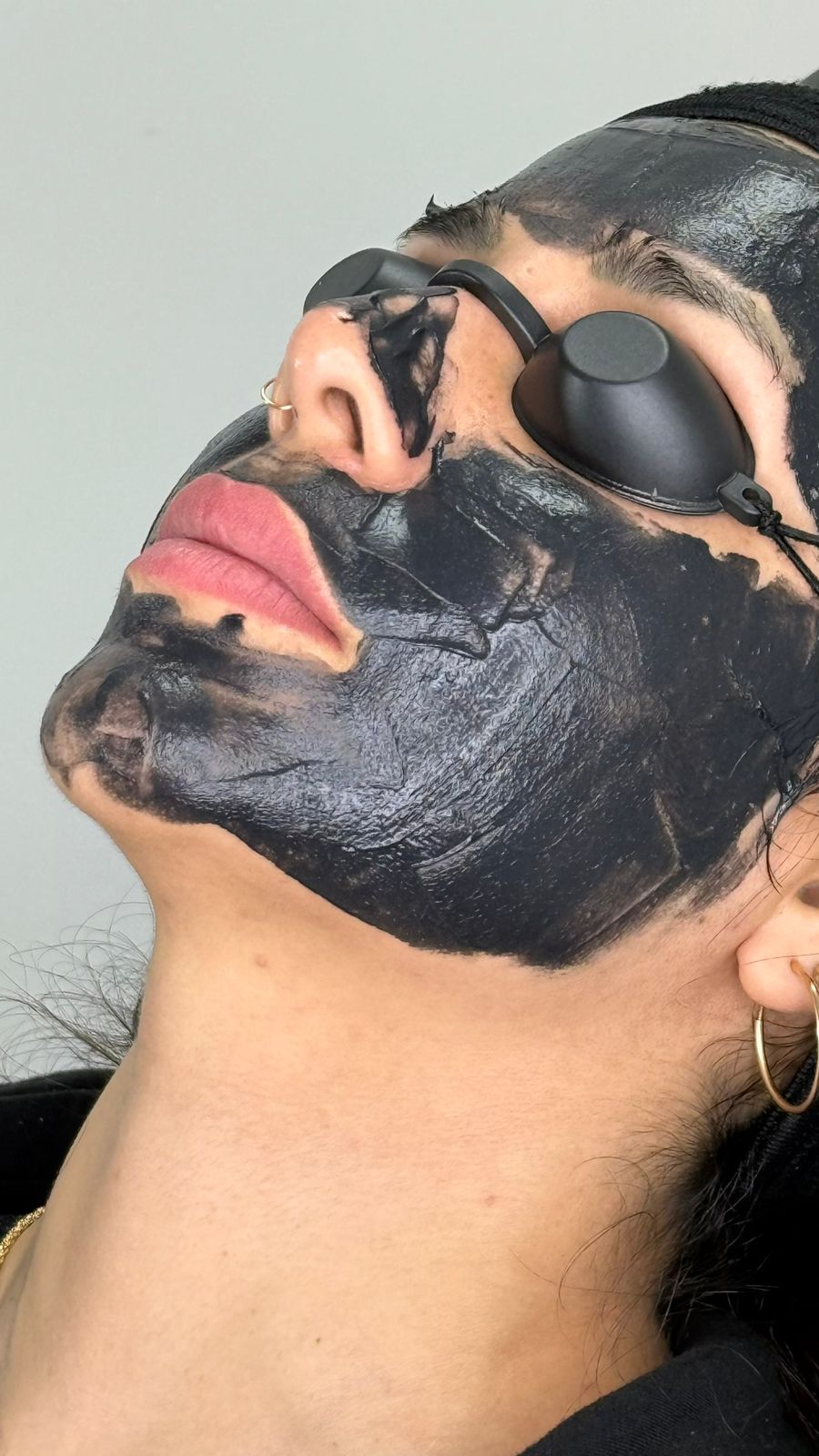 Hollywood Peel   (Láser Q-Switch con carbón activo)