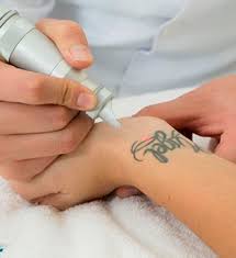 Borrado de Tatuajes - M (6 - 10 cm)