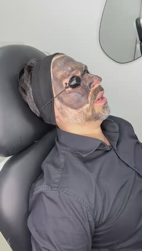 Hollywood Peel   (Láser Q-Switch con carbón activo)