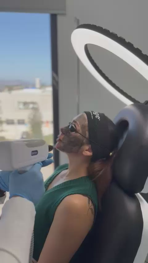 Hollywood Peel   (Láser Q-Switch con carbón activo)